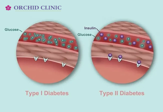 Expert Diabetic Treatment In Vadodara for Type 1 and Type 2 Diabetes